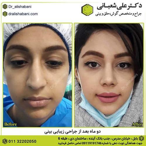 جراحی-بینی-412