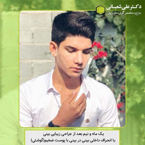 جراحی-بینی-413