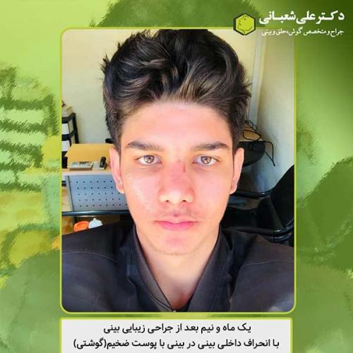 جراحی-بینی-414