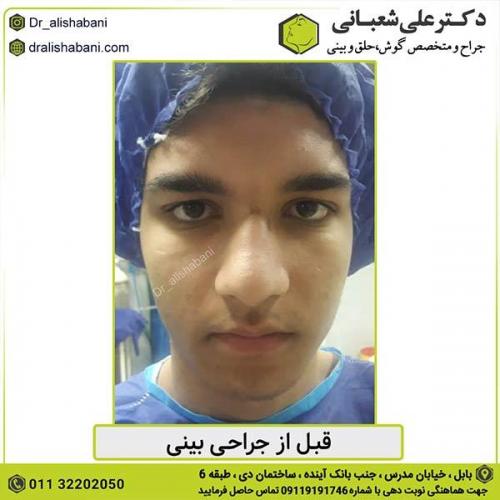 جراحی-بینی-415