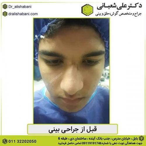 جراحی-بینی-416