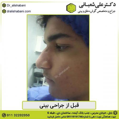 جراحی-بینی-417