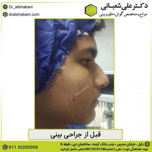 جراحی-بینی-418