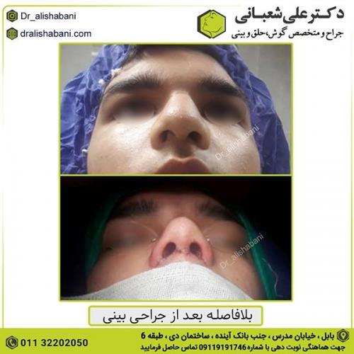 جراحی-بینی-419