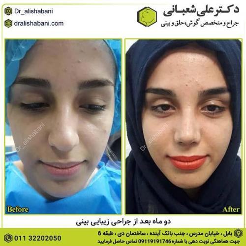 جراحی-بینی-420