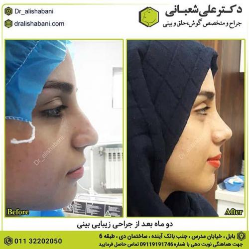 جراحی-بینی-422