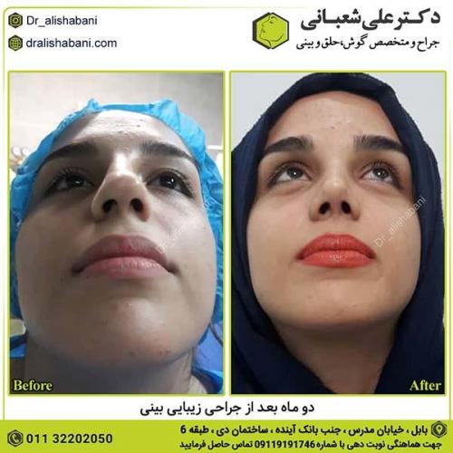 جراحی-بینی-423