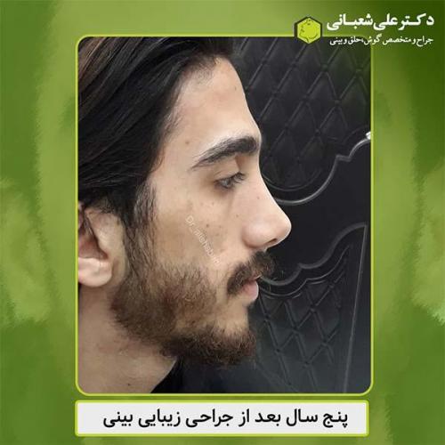 جراحی-بینی-424