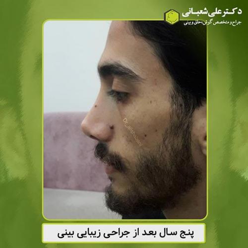 جراحی-بینی-426
