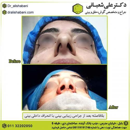 جراحی-بینی-427