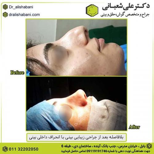 جراحی-بینی-428