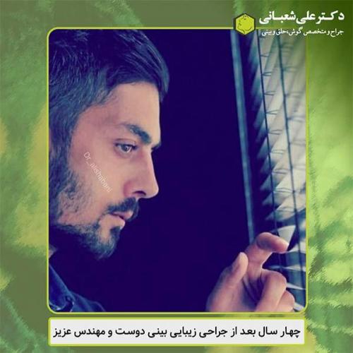 جراحی-بینی-429