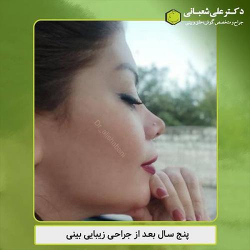 جراحی-بینی-433