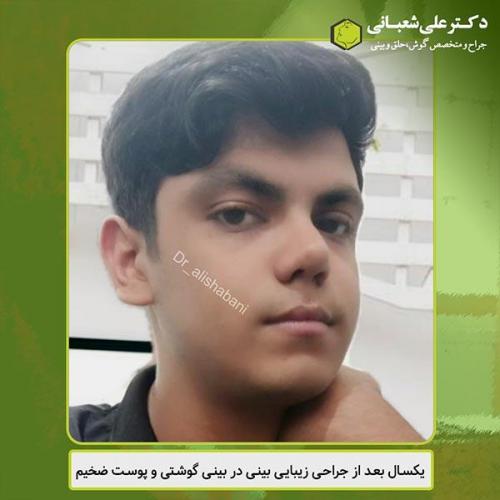 جراحی-بینی-435