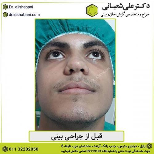 جراحی-بینی-436