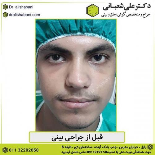 جراحی-بینی-437