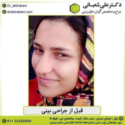 جراحی-بینی-442
