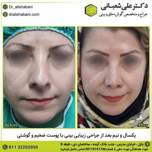 جراحی-بینی-444