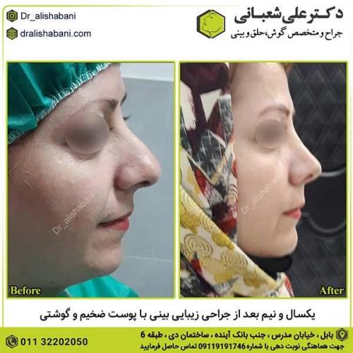 جراحی-بینی-445