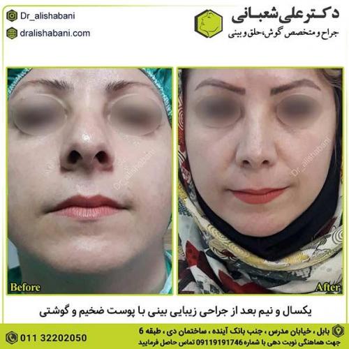 جراحی-بینی-446