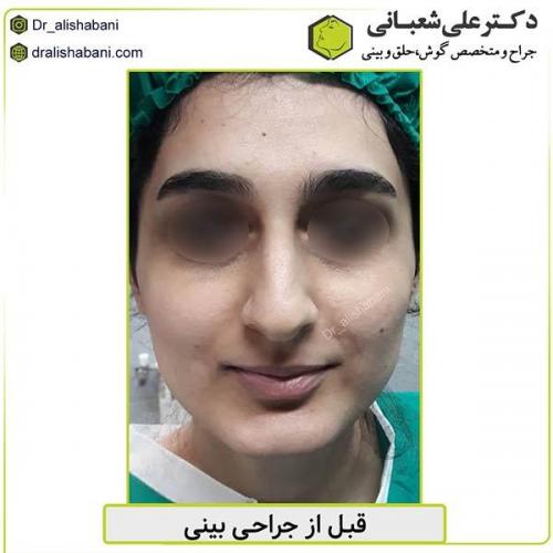جراحی-بینی-447