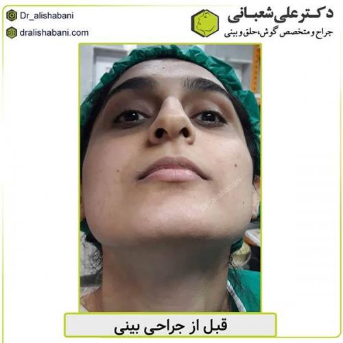 جراحی-بینی-448