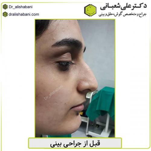 جراحی-بینی-449