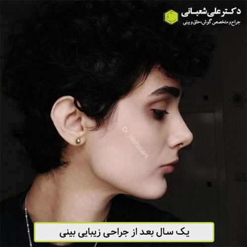 جراحی-بینی-451