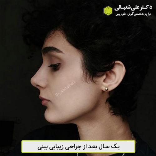 جراحی-بینی-452
