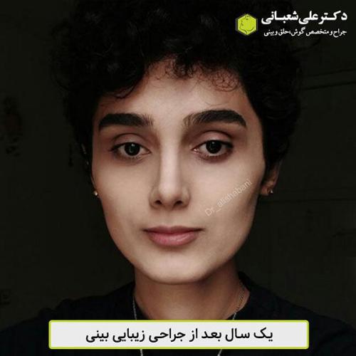 جراحی-بینی-453