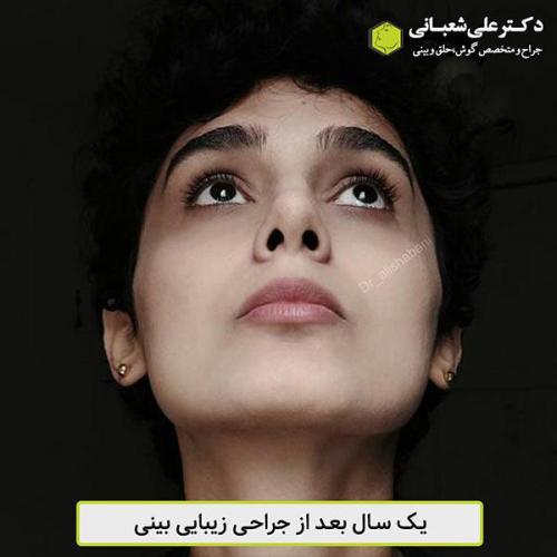 جراحی-بینی-456