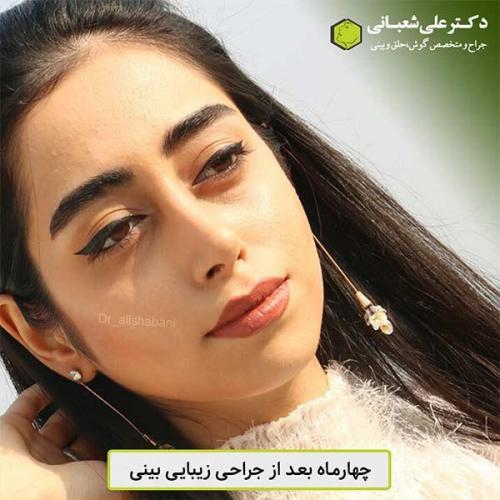 جراحی-بینی-457