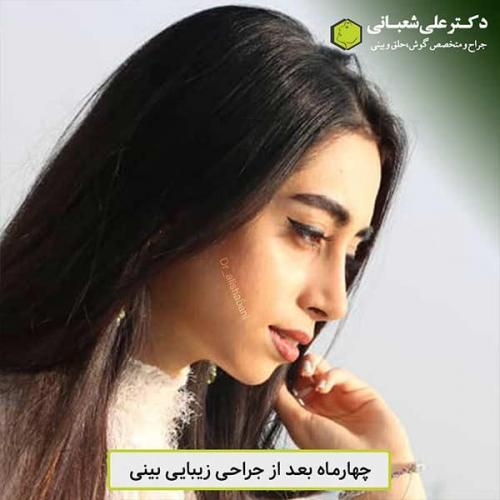 جراحی-بینی-459