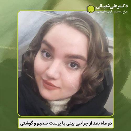 جراحی-بینی-462