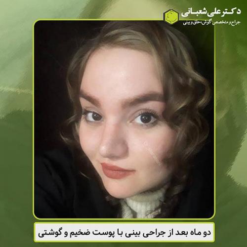 جراحی-بینی-463