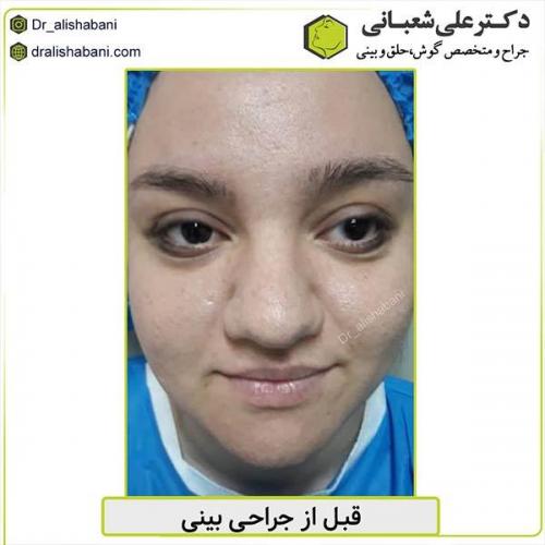 جراحی-بینی-465