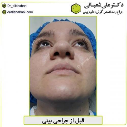 جراحی-بینی-466