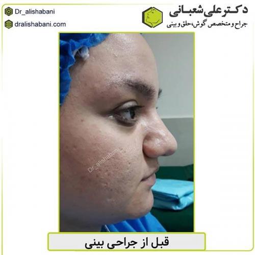 جراحی-بینی-467
