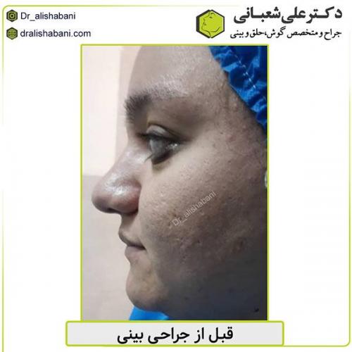 جراحی-بینی-468