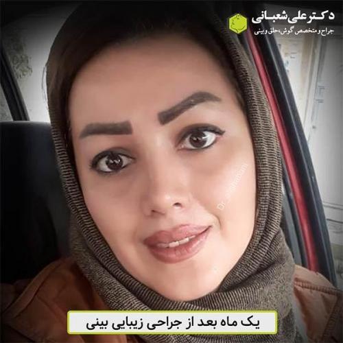 جراحی-بینی-469