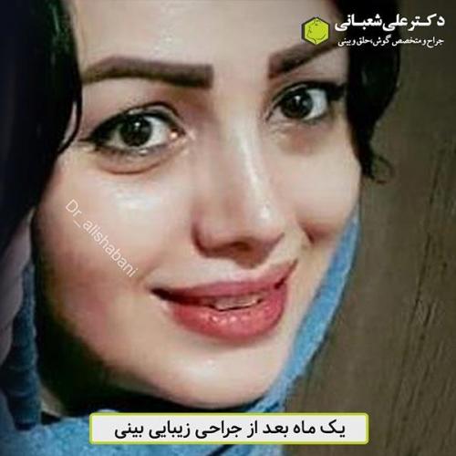 جراحی-بینی-471