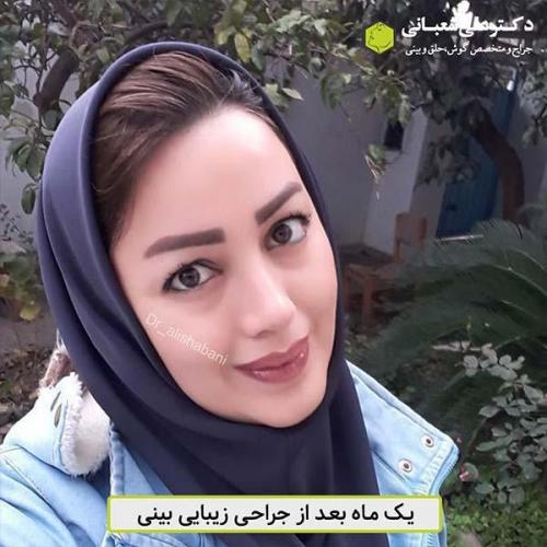 جراحی-بینی-472