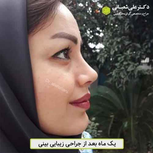 جراحی-بینی-473