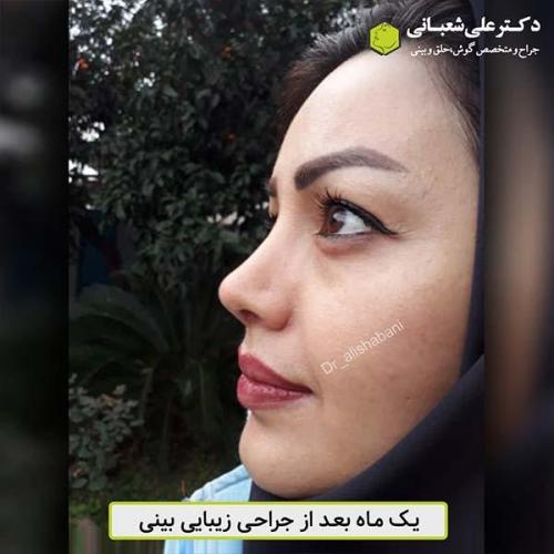 جراحی-بینی-474
