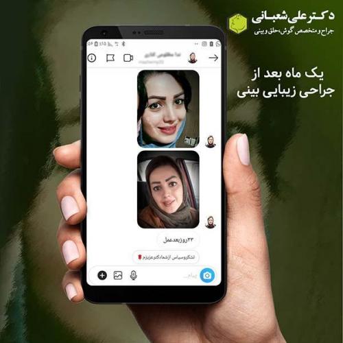 جراحی-بینی-475