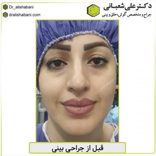 جراحی-بینی-476