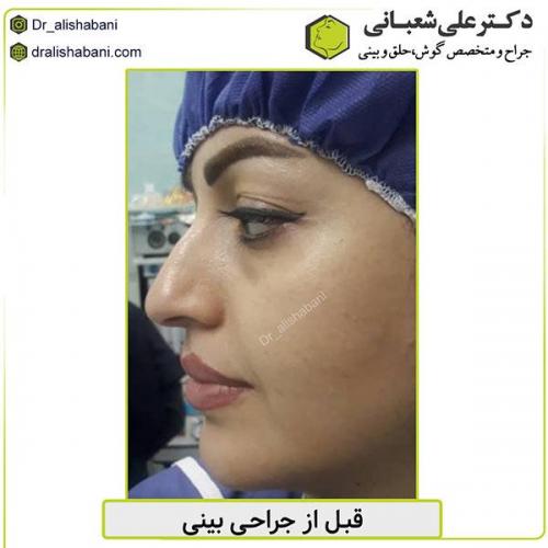 جراحی-بینی-477