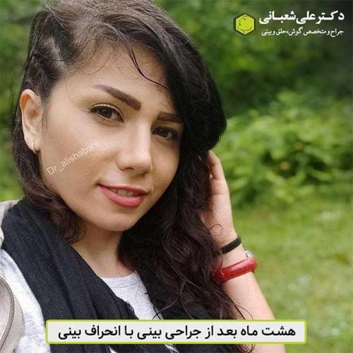 جراحی-بینی-479