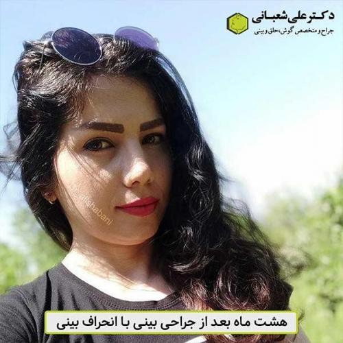 جراحی-بینی-480