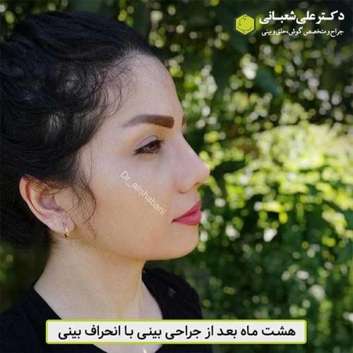 جراحی-بینی-481